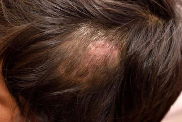 Hair Micropigmentation done on areas affected by alopecia