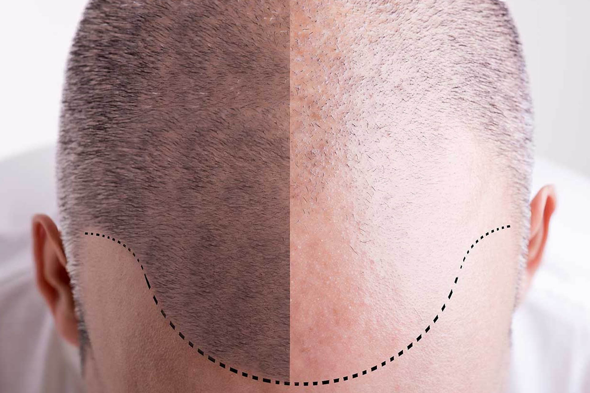 hair micropigmentation design