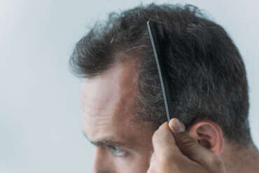 Hair Micropigmentation after general hair loss