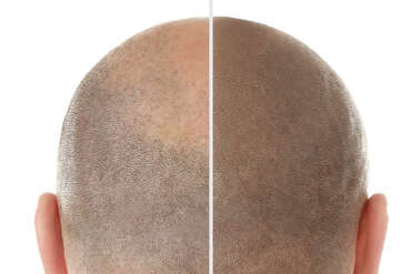 What is Hair micropigmentation?