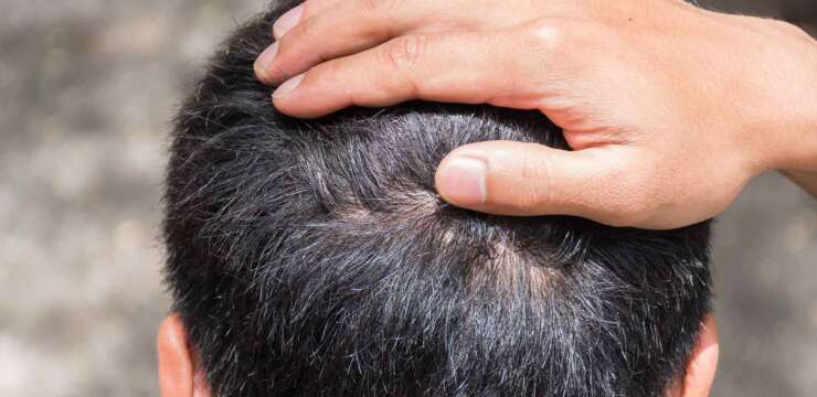 Comment se passe la procédure FUT et FUE et de simulation capillaire dans la cicatrice après la greffe de cheveux ?