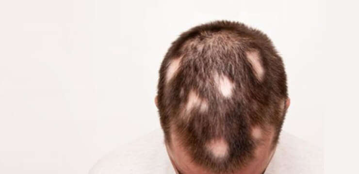 Simulation Capillaire d’Alopécie (Chute des Cheveux)