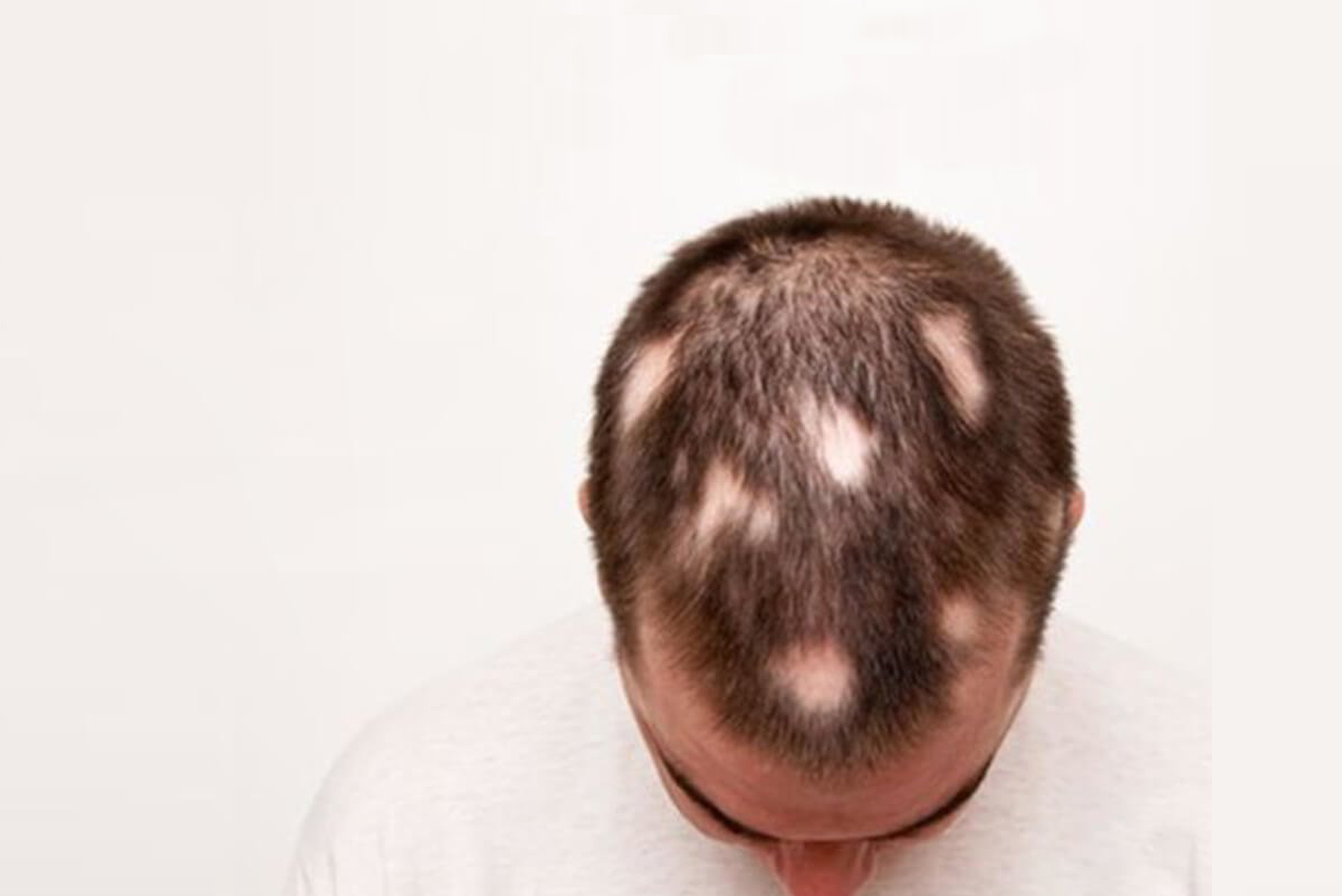 Simulation Capillaire d’Alopécie (Chute des Cheveux)
