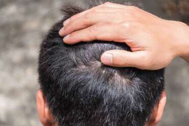 La micropigmentazione dopo il trapianto di capelli e sulle aree cicatriziali causate dalle tecniche FUT e FUE