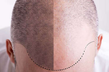 Come viene realizzato il design nella micropigmentazione dei capelli?