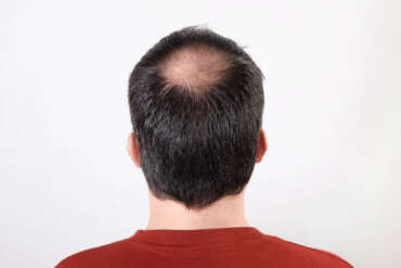 È possibile rimuovere la micropigmentazione dei capelli?