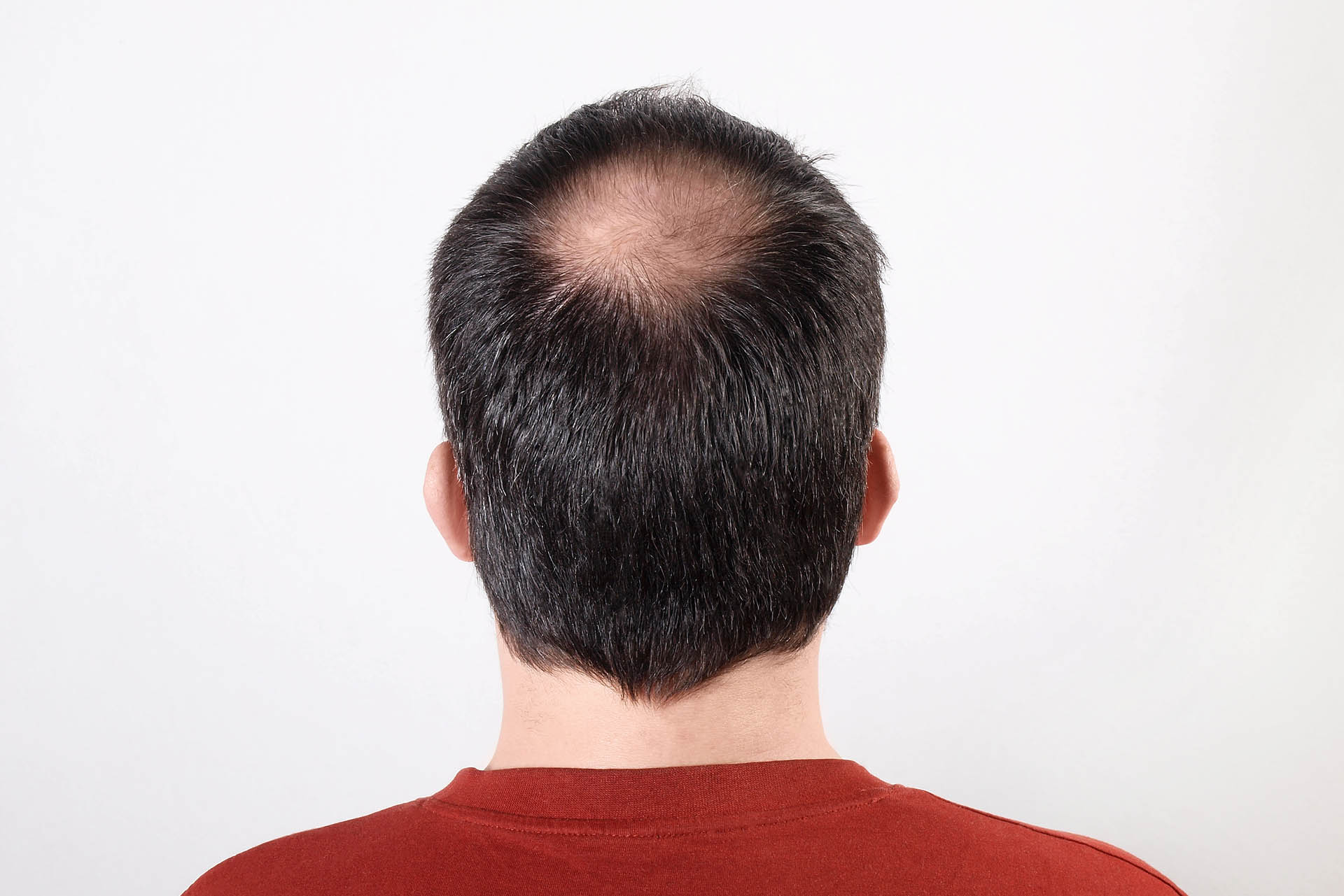 È possibile rimuovere la micropigmentazione dei capelli?