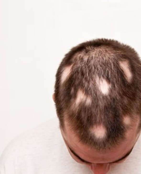 Micropigmentazione del Capello Dopo Alopecia (Tigna)