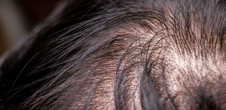 Chi può o non può sottoporsi alla micropigmentazione dei capelli